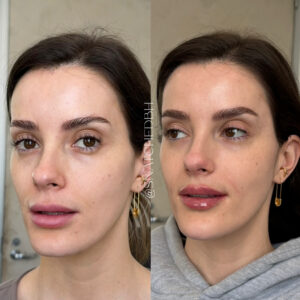 Facial balancing: lips and temples. All the way from Georgia.