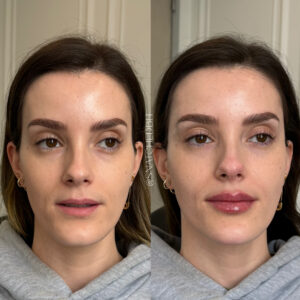 Facial balancing: lips and temples. All the way from Georgia. (1)