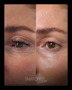 SNATCHED-CO2-LASER (2)