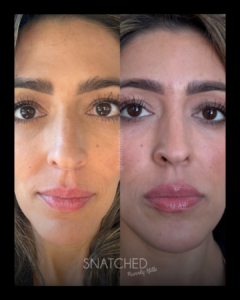 SNATCHED-SCULPTRA (2)