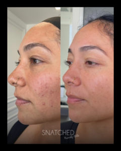SNATCHED-SKIN-REJUVENATION-PT6