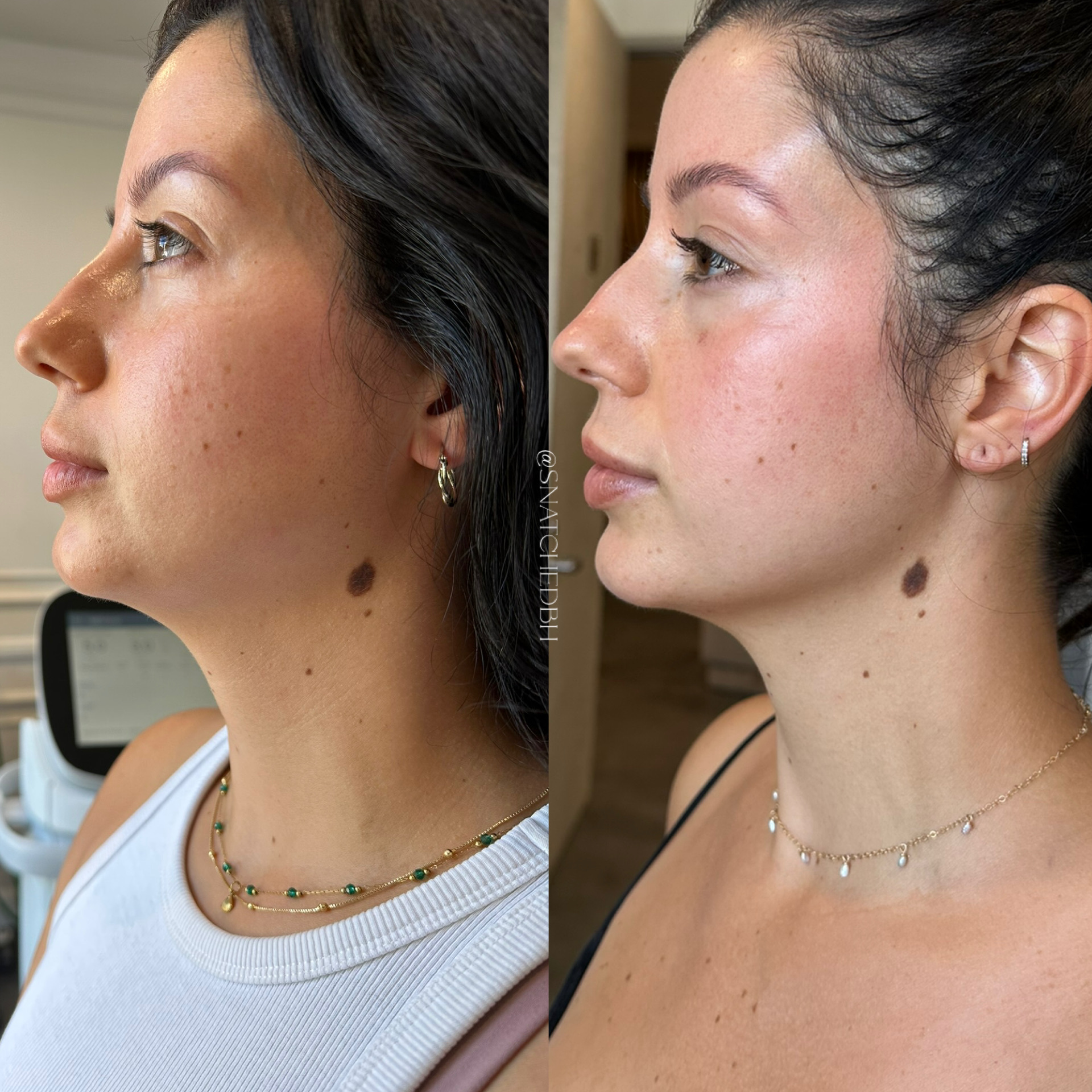 Before and after result 6